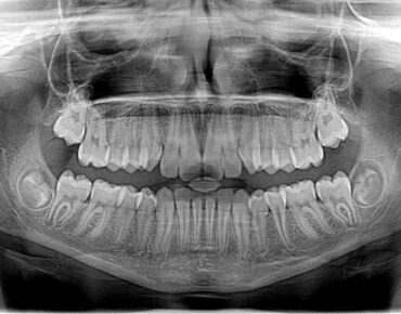 dantų rentgenas
