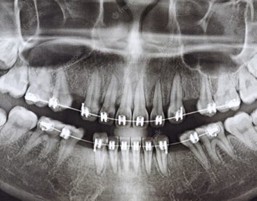 panoraminė dantų nuotrauka